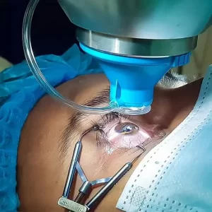 LASIK Eye Surgery