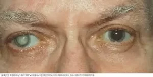 Cataract Common Eye Diseases and Their Treatments: A Complete Guide