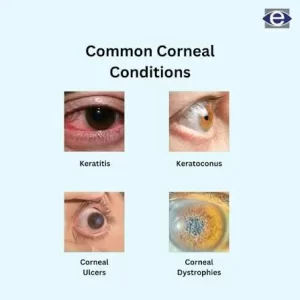 Corneal Diseases