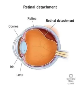 Retinal Detachment Common Eye Diseases and Their Treatments: A Complete Guide